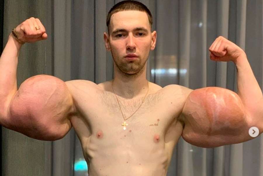 Ruský Pepek chtěl okouzlit krásné dívky, tak si napíchal bicepsy olejem